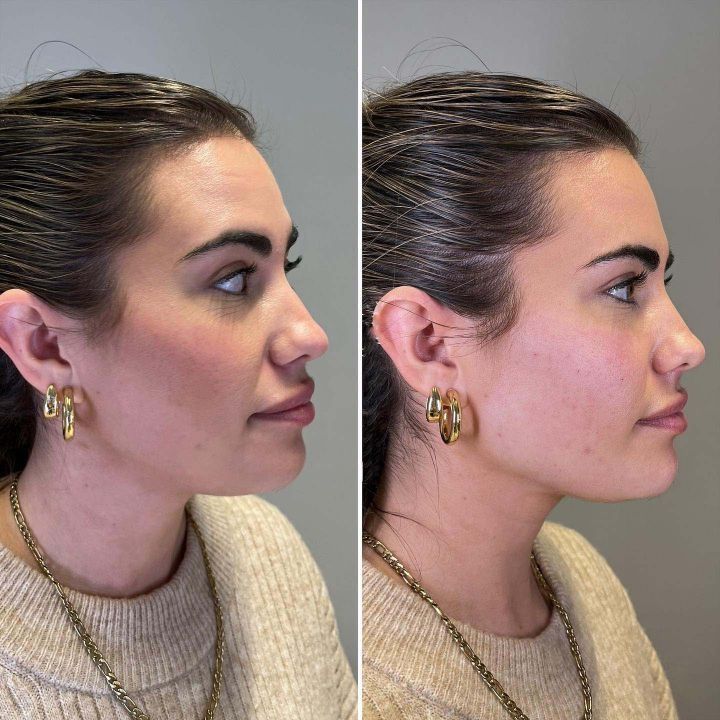 Jawline contouring with Botox in Bourbonnais IL