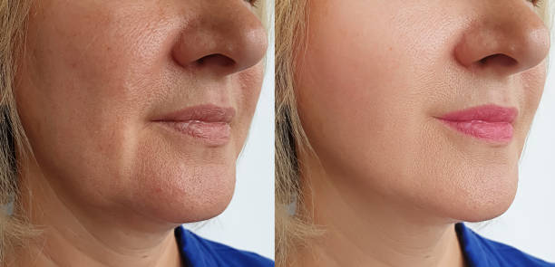 Jawline Filler in Abu Dhabi