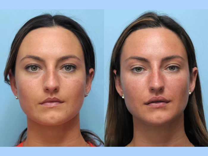 Best Plastic Surgeon in Dubai Providing Thread Lift for Natural Skin Rejuvenation Without Surgery