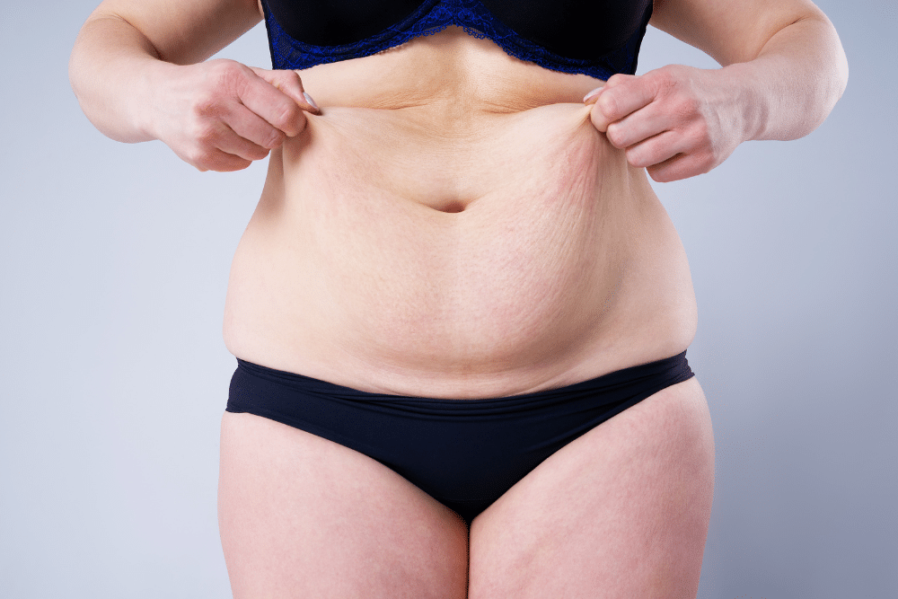 Mini tummy tuck dubai