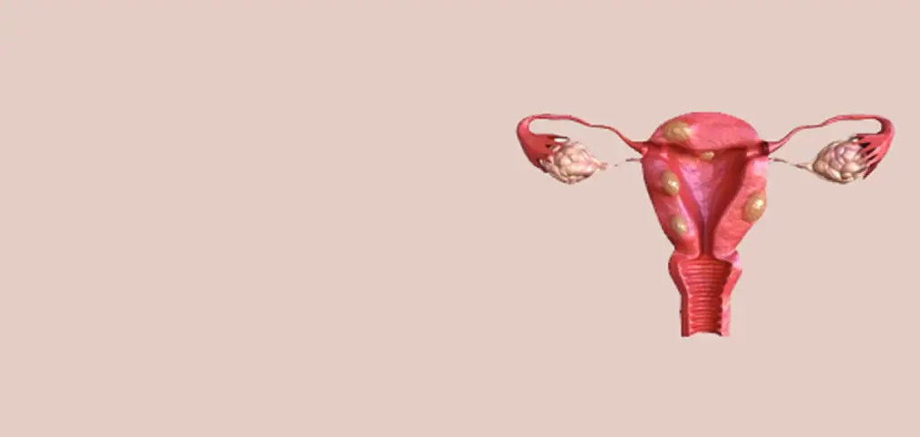 uterine-fibroid-embolization